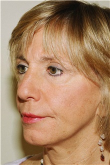 Rhinoplasty Before Photo by Steve Laverson, MD, FACS; Rancho Santa Fe, CA - Case 41293