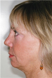 Rhinoplasty After Photo by Steve Laverson, MD, FACS; Rancho Santa Fe, CA - Case 41293