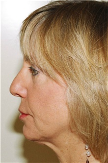 Rhinoplasty Before Photo by Steve Laverson, MD, FACS; Rancho Santa Fe, CA - Case 41293