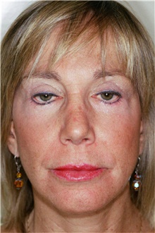 Rhinoplasty After Photo by Steve Laverson, MD, FACS; Rancho Santa Fe, CA - Case 41293