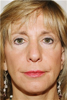 Rhinoplasty Before Photo by Steve Laverson, MD, FACS; Rancho Santa Fe, CA - Case 41293