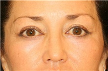 Eyelid Surgery After Photo by Steve Laverson, MD, FACS; Rancho Santa Fe, CA - Case 41304