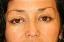 Eyelid Surgery Before Photo by Steve Laverson, MD, FACS; Rancho Santa Fe, CA - Case 41304