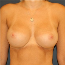 Breast Augmentation After Photo by Steve Laverson, MD, FACS; Rancho Santa Fe, CA - Case 41305