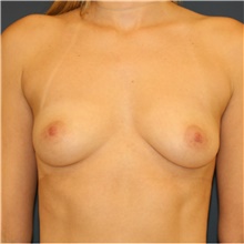 Breast Augmentation Before Photo by Steve Laverson, MD, FACS; Rancho Santa Fe, CA - Case 41305