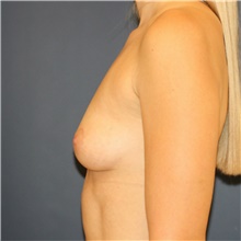 Breast Augmentation Before Photo by Steve Laverson, MD, FACS; Rancho Santa Fe, CA - Case 41305