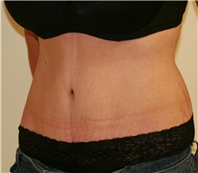 Tummy Tuck After Photo by Steve Laverson, MD, FACS; San Diego, CA - Case 41321
