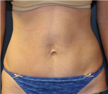 Tummy Tuck After Photo by Steve Laverson, MD, FACS; Rancho Santa Fe, CA - Case 41322