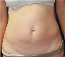 Tummy Tuck Before Photo by Steve Laverson, MD, FACS; Rancho Santa Fe, CA - Case 41322