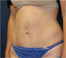 Tummy Tuck After Photo by Steve Laverson, MD, FACS; Rancho Santa Fe, CA - Case 41322