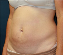 Tummy Tuck Before Photo by Steve Laverson, MD, FACS; Rancho Santa Fe, CA - Case 41322