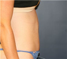 Tummy Tuck After Photo by Steve Laverson, MD, FACS; Rancho Santa Fe, CA - Case 41322