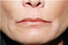 Lip Augmentation/Enhancement After Photo by Steve Laverson, MD, FACS; Rancho Santa Fe, CA - Case 41328