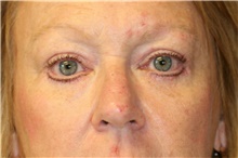 Eyelid Surgery After Photo by Steve Laverson, MD; San Diego, CA - Case 41329