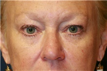 Eyelid Surgery Before Photo by Steve Laverson, MD; San Diego, CA - Case 41329