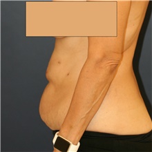 Tummy Tuck Before Photo by Steve Laverson, MD, FACS; Rancho Santa Fe, CA - Case 41352