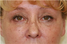 Eyelid Surgery After Photo by Steve Laverson, MD, FACS; Rancho Santa Fe, CA - Case 41424