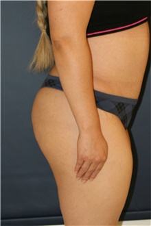 Buttock Lift with Augmentation Before and After Photos