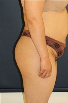 Buttock lift and Augmentation Before and After Gallery