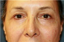 Eyelid Surgery After Photo by Steve Laverson, MD; San Diego, CA - Case 41464