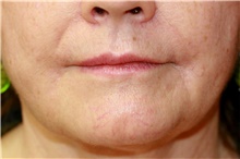 Lip Augmentation/Enhancement After Photo by Steve Laverson, MD, FACS; Rancho Santa Fe, CA - Case 41472