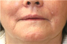 Lip Augmentation/Enhancement Before Photo by Steve Laverson, MD, FACS; Rancho Santa Fe, CA - Case 41472