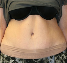 Tummy Tuck After Photo by Steve Laverson, MD, FACS; Rancho Santa Fe, CA - Case 41474