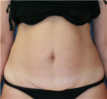 Tummy Tuck Before Photo by Steve Laverson, MD, FACS; Rancho Santa Fe, CA - Case 41474