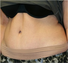 Tummy Tuck After Photo by Steve Laverson, MD, FACS; Rancho Santa Fe, CA - Case 41474