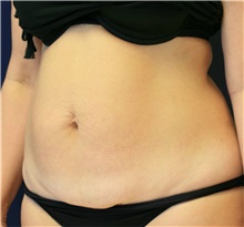 Tummy Tuck Before Photo by Steve Laverson, MD, FACS; Rancho Santa Fe, CA - Case 41474