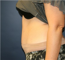 Tummy Tuck After Photo by Steve Laverson, MD, FACS; Rancho Santa Fe, CA - Case 41474