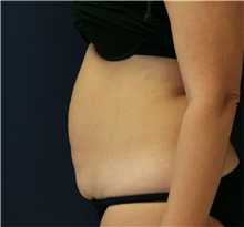 Tummy Tuck Before Photo by Steve Laverson, MD, FACS; Rancho Santa Fe, CA - Case 41474