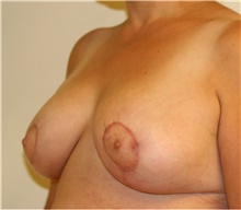 Breast Reduction After Photo by Steve Laverson, MD, FACS; Rancho Santa Fe, CA - Case 41478