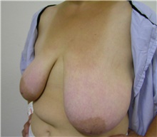 Breast Reduction Before Photo by Steve Laverson, MD, FACS; Rancho Santa Fe, CA - Case 41478