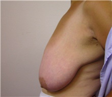 Breast Reduction Before Photo by Steve Laverson, MD, FACS; San Diego, CA - Case 41478