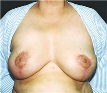 Breast Reduction After Photo by Steve Laverson, MD, FACS; San Diego, CA - Case 41479