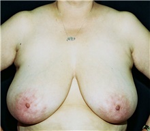 Breast Reduction Before Photo by Steve Laverson, MD, FACS; Rancho Santa Fe, CA - Case 41479