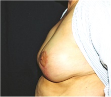 Breast Reduction After Photo by Steve Laverson, MD, FACS; Rancho Santa Fe, CA - Case 41479