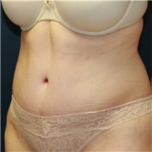 Tummy Tuck After Photo by Steve Laverson, MD, FACS; Rancho Santa Fe, CA - Case 41491