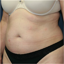 Tummy Tuck Before Photo by Steve Laverson, MD, FACS; Rancho Santa Fe, CA - Case 41491