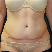 Tummy Tuck After Photo by Steve Laverson, MD, FACS; Rancho Santa Fe, CA - Case 41491