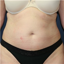 Tummy Tuck Before Photo by Steve Laverson, MD, FACS; Rancho Santa Fe, CA - Case 41491