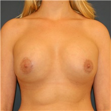 Breast Lift After Photo by Steve Laverson, MD, FACS; Rancho Santa Fe, CA - Case 41497