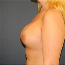 Breast Lift After Photo by Steve Laverson, MD, FACS; Rancho Santa Fe, CA - Case 41497