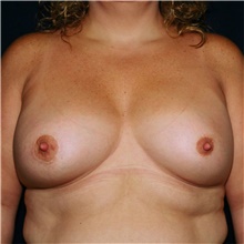 Breast Lift After Photo by Steve Laverson, MD; San Diego, CA - Case 41498