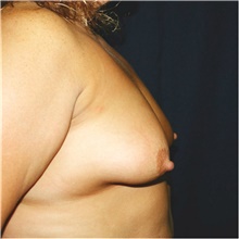 Breast Lift Before Photo by Steve Laverson, MD, FACS; San Diego, CA - Case 41498