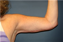 Arm Lift After Photo by Steve Laverson, MD, FACS; San Diego, CA - Case 41515