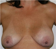 Breast Lift Before Photo by Steve Laverson, MD, FACS; Rancho Santa Fe, CA - Case 41525
