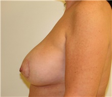 Breast Lift After Photo by Steve Laverson, MD, FACS; Rancho Santa Fe, CA - Case 41525