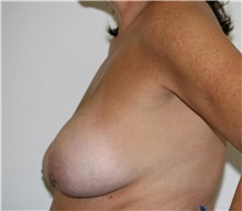 Breast Lift Before Photo by Steve Laverson, MD, FACS; Rancho Santa Fe, CA - Case 41525